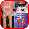 Lupus: Causes, Diagnosis, and Treatment icon